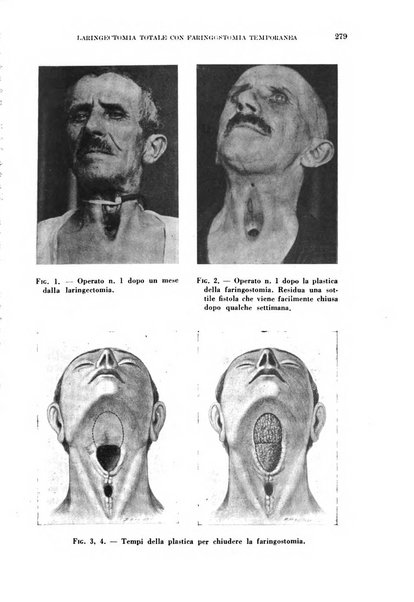 Il Valsalva rivista mensile di oto-rino-laringojatria