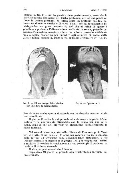 Il Valsalva rivista mensile di oto-rino-laringojatria