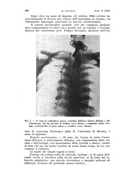 Il Valsalva rivista mensile di oto-rino-laringojatria