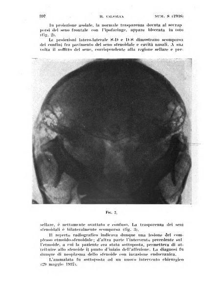 Il Valsalva rivista mensile di oto-rino-laringojatria