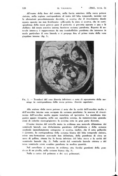 Il Valsalva rivista mensile di oto-rino-laringojatria