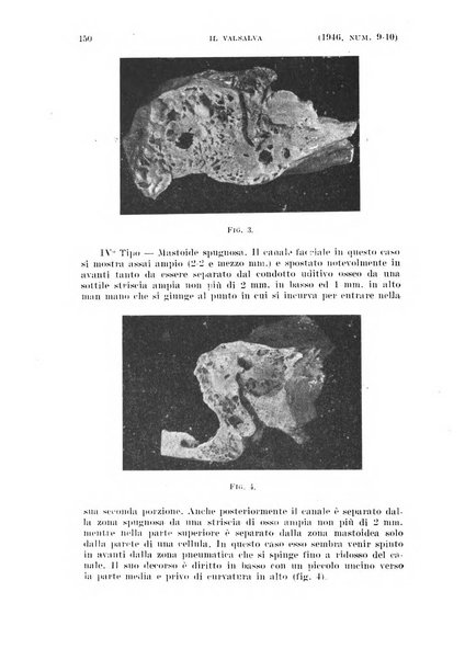 Il Valsalva rivista mensile di oto-rino-laringojatria