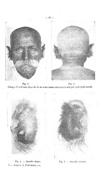 Archivio di psichiatria, neuropatologia, antropologia criminale e medicina legale