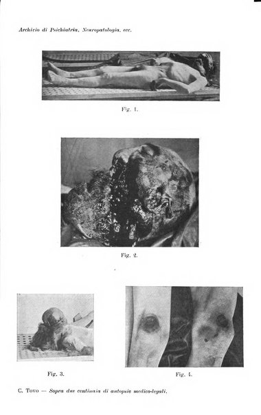 Archivio di psichiatria, neuropatologia, antropologia criminale e medicina legale